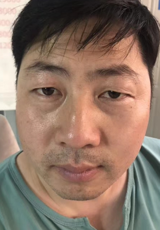 去眼袋手术