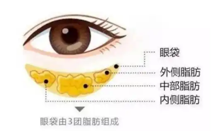 去眼袋手术
