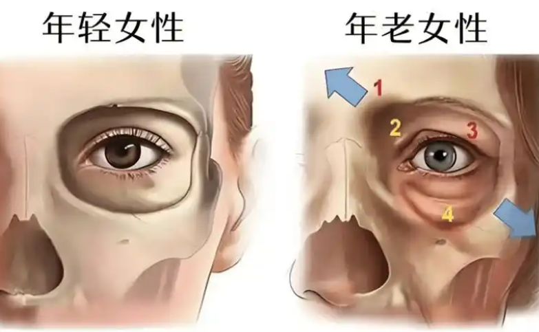 去眼袋手术