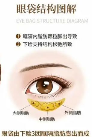 去眼袋手术