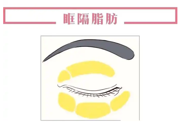 去眼袋手术