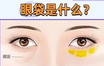 去眼袋手术