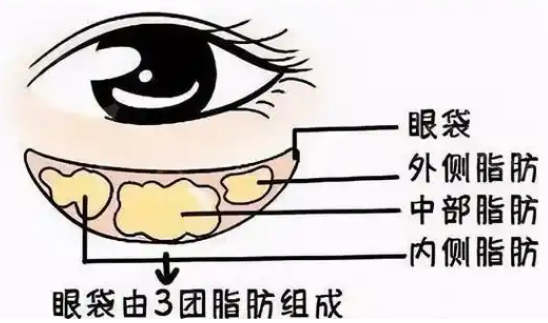 去眼袋手术
