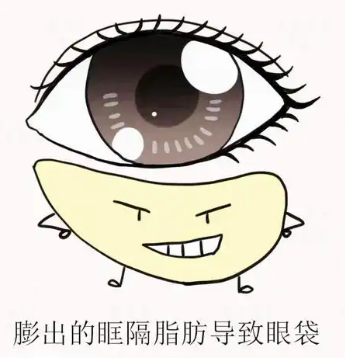 去眼袋手术