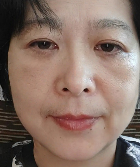 去眼袋手术