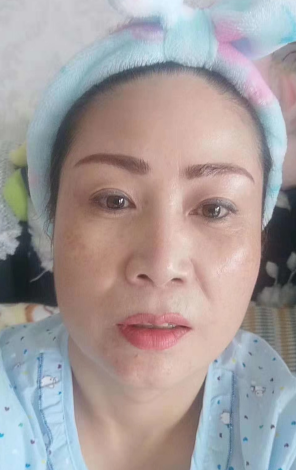 去眼袋手术