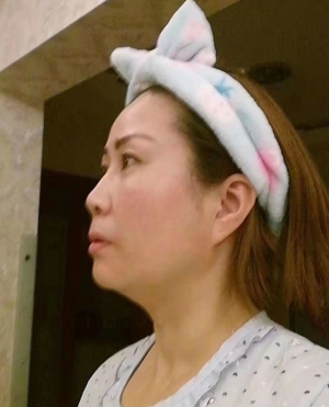 去眼袋手术