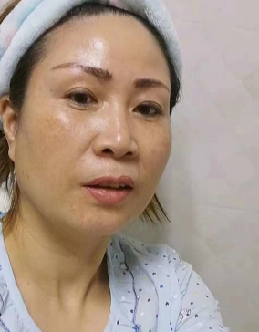 去眼袋手术