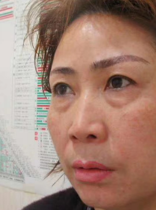 去眼袋手术