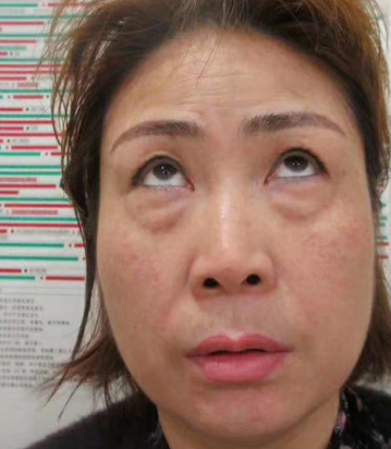 去眼袋手术