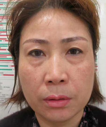去眼袋手术