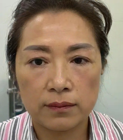 去眼袋手术