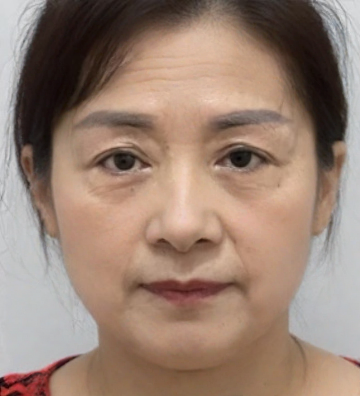 去眼袋手术