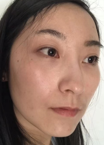 去眼袋手术