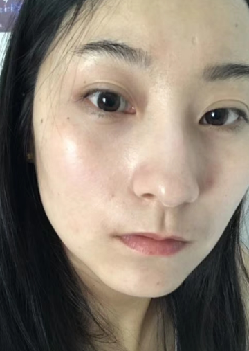 去眼袋手术