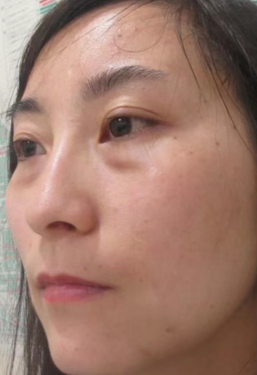 去眼袋手术