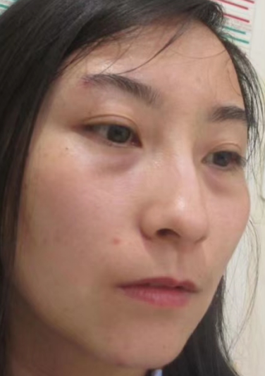 去眼袋手术