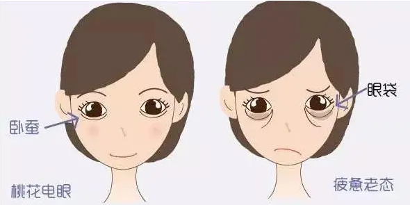 去眼袋手术