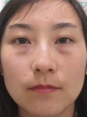 去眼袋手术
