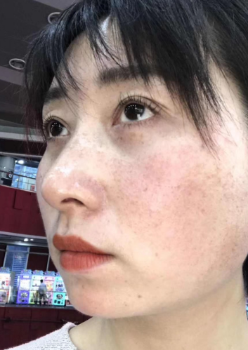 去眼袋手术