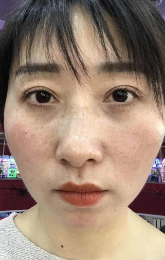 去眼袋手术