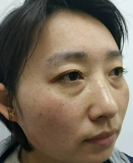 去眼袋手术