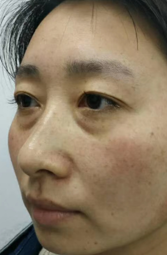 去眼袋手术