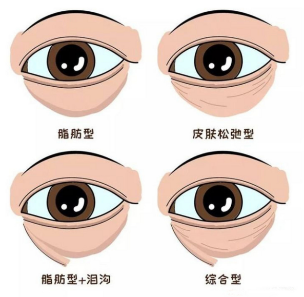 去眼袋手术