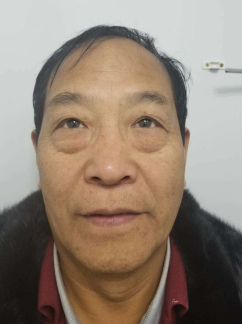 去眼袋手术