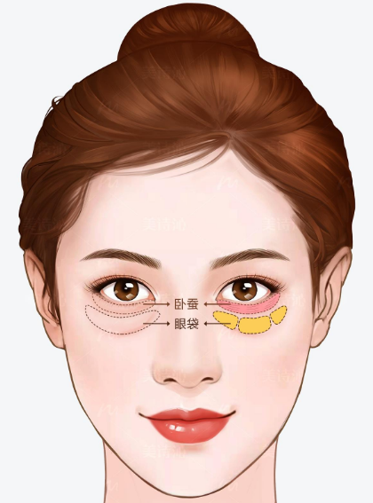 眼袋