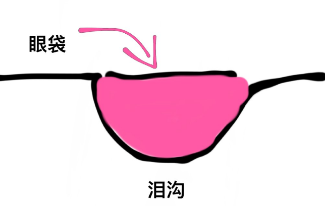 眼袋