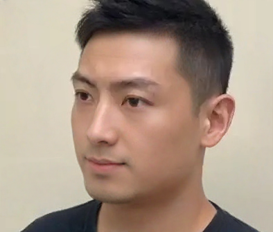 去眼袋手术