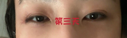 去眼袋手术