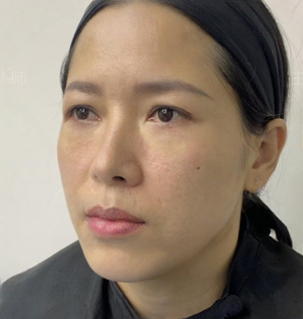 去眼袋手术