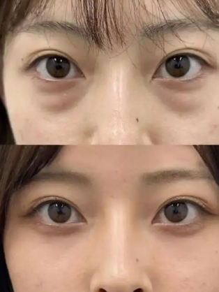 去眼袋手术
