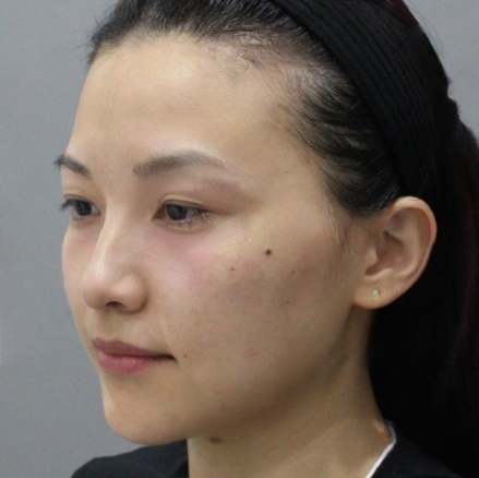 去眼袋手术