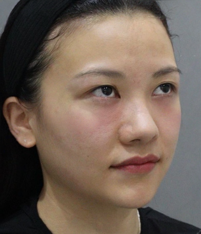 去眼袋手术