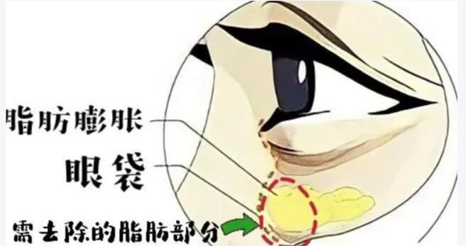 去眼袋手术