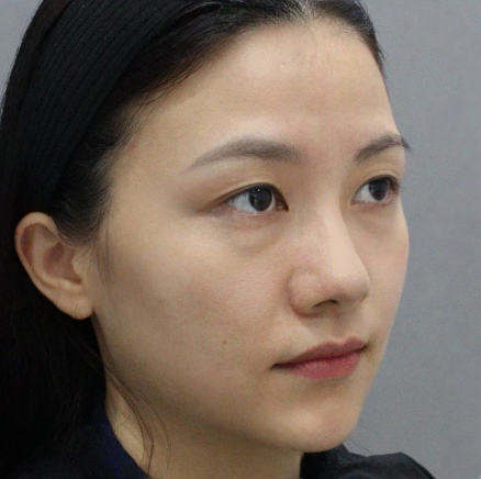 去眼袋手术
