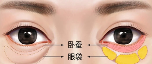 去眼袋手术