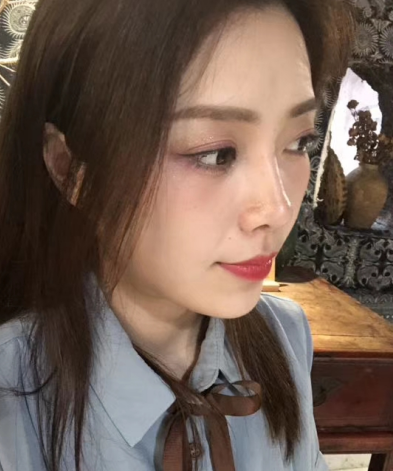 去眼袋手术