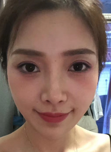 去眼袋手术