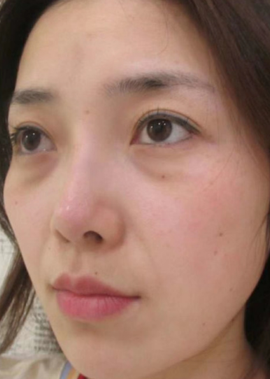 去眼袋手术