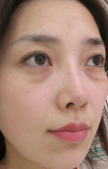 去眼袋手术