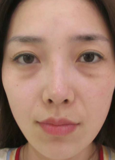 去眼袋手术