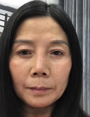 去眼袋手术