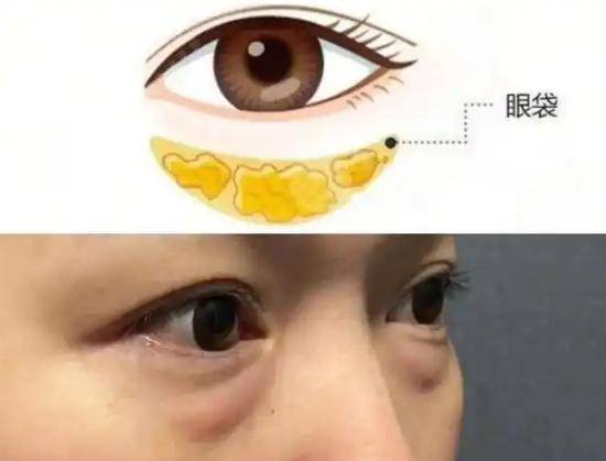去眼袋手术