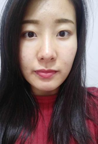 去眼袋手术
