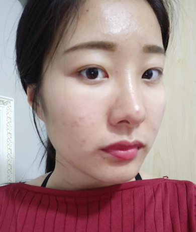 去眼袋手术
