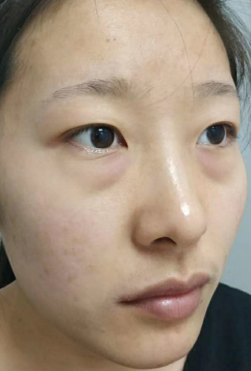 去眼袋手术